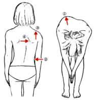 背骨のゆがみ 側弯 による背中の盛り上がりについて