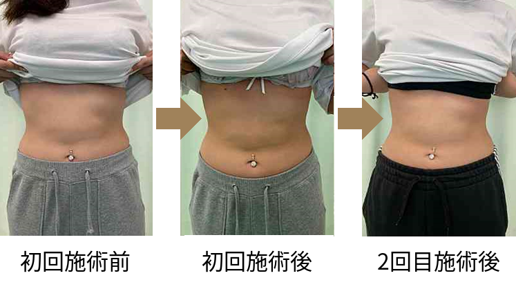 東京の肋骨矯正専門整体院。肋骨矯正 肋骨の開きビフォーアフター写真