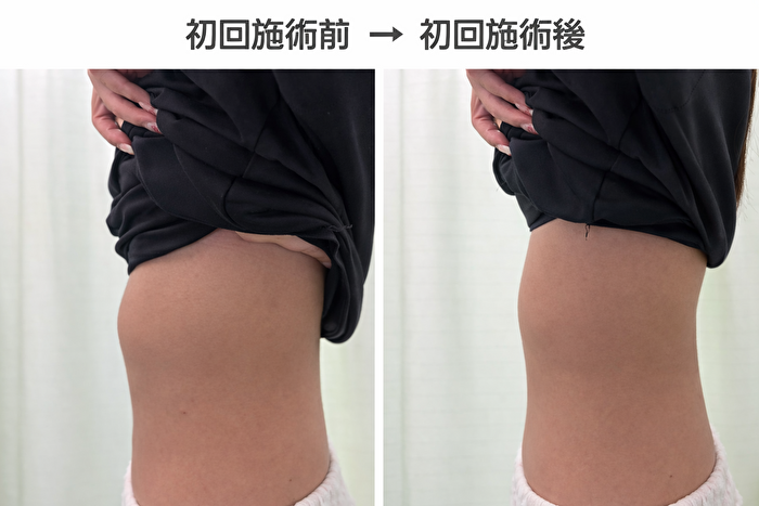 東京の肋骨矯正専門整体院。肋骨の出っ張りビフォーアフター