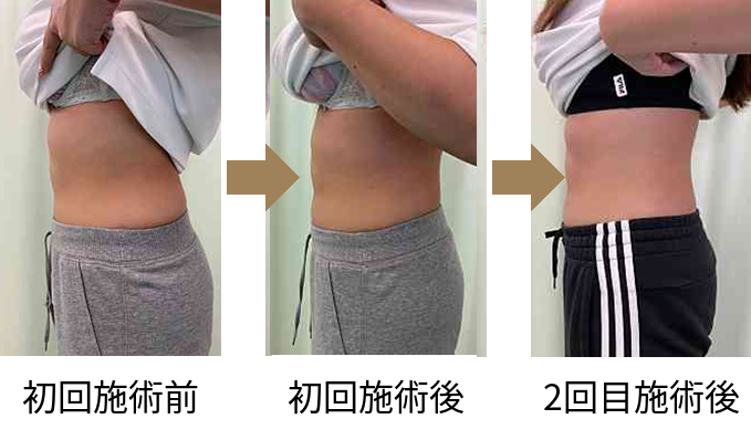 東京の肋骨矯正専門整体院。肋骨矯正 肋骨の出っ張りビフォーアフター写真