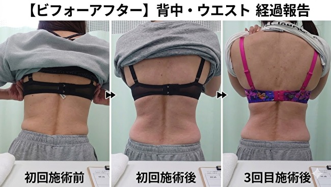 東京の肋骨矯正専門整体院。肋骨矯正 くびれビフォーアフター