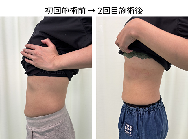 東京府中の肋骨矯正専門整体院「紅葉丘整骨院」肋骨矯正ビフォーアフター画像野村さん