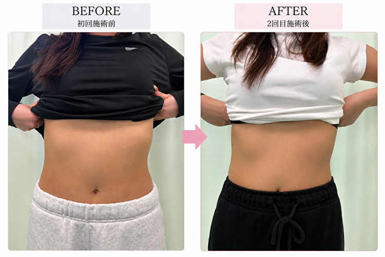 東京府中の肋骨矯正専門整体院「紅葉丘整骨院」肋骨矯正ビフォーアフター肋骨の開き・広がり改善