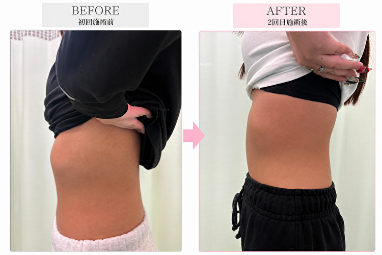 東京府中の肋骨矯正専門整体院「紅葉丘整骨院」肋骨矯正ビフォーアフター肋骨の出っ張り改善