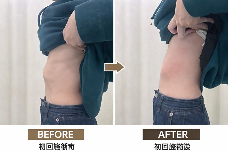 東京府中の肋骨矯正専門整体「紅葉丘整骨院」
肋骨の出っ張り改善ビフォーアフター